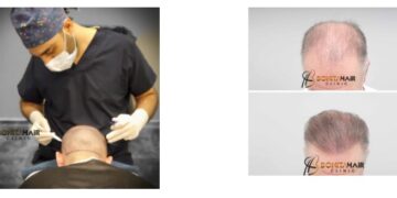 When Is A Hair Transplant The Right Solution For You? Which is the Best Clinic in Belgium?