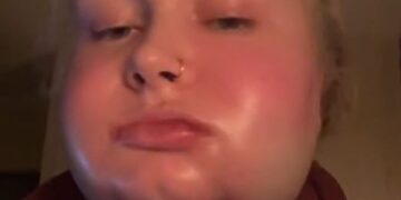 Hospitality worker recovery after jaw surgery which left "chipmunk vibes"