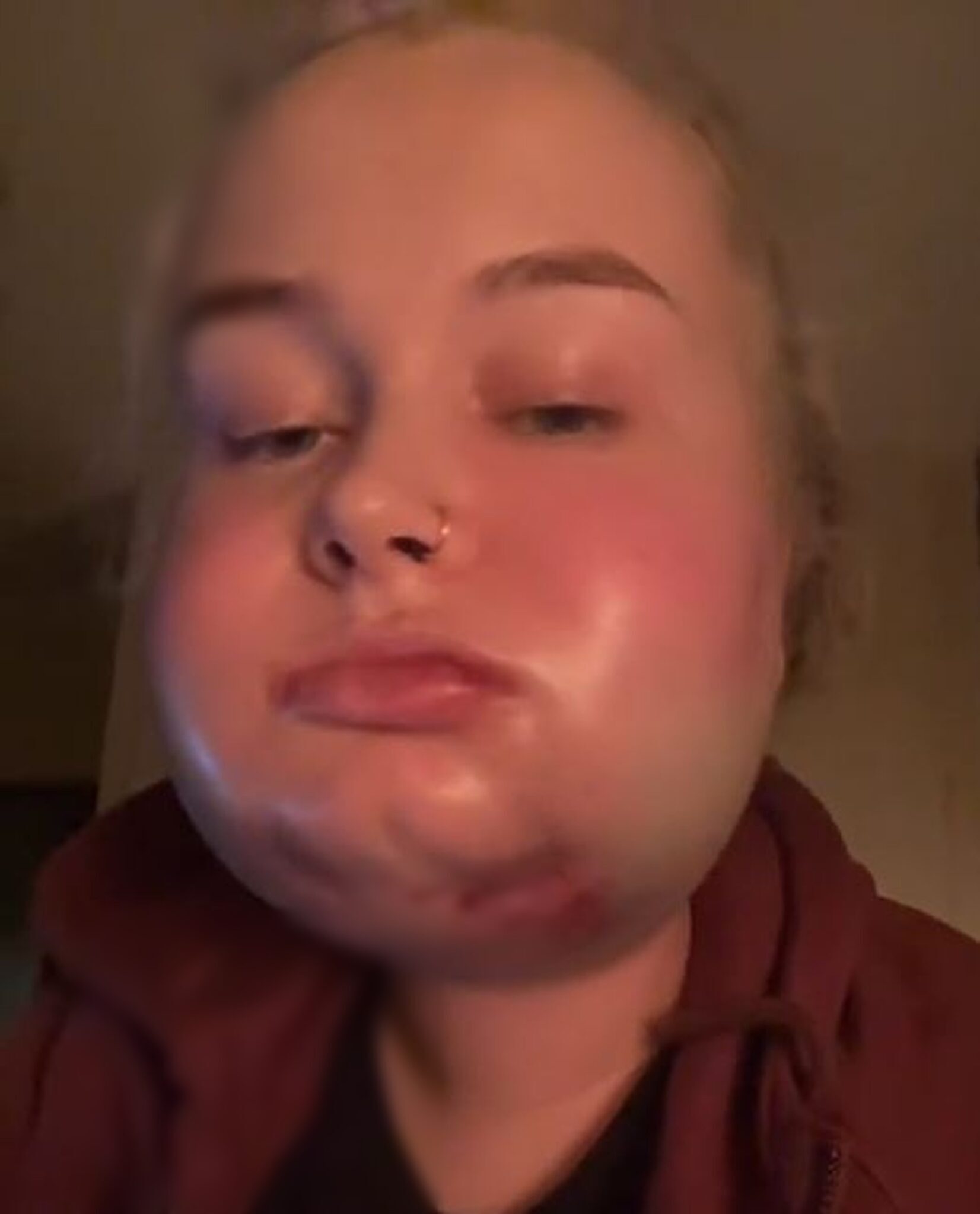 Hospitality worker recovery after jaw surgery which left "chipmunk vibes"
